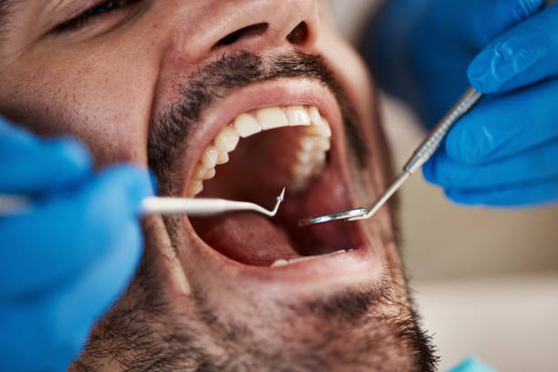 Best Emergency Dental Extractions in Shippensburg University, PA